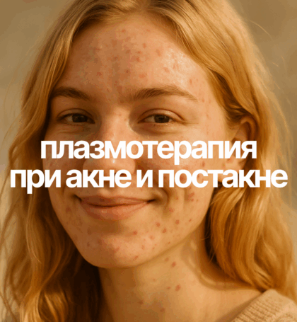 Плазмотерапия при акне и постакне